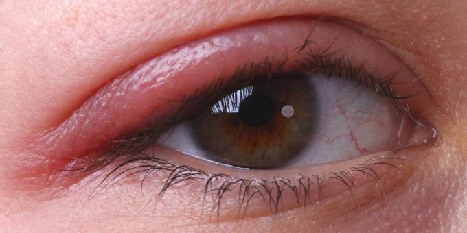Waarom jeukende ogen: blefaritis