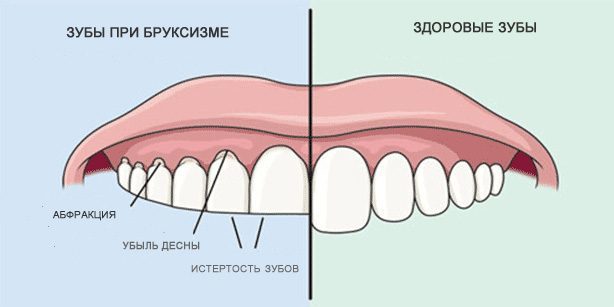 Tandenknarsen: Gezonde tanden en tanden tijdens bruxisme