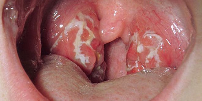 symptomen van tonsillitis