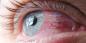 Conjunctivitis: waarom rood worden de ogen en hoe ze te behandelen