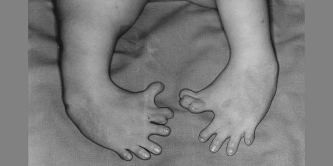 Misvorming van de benen van een pasgeborene wiens moeder thalidomide gebruikte. De bijwerkingen van het medicijn worden een voorbeeld van de acties van Big Pharma genoemd.