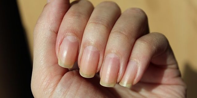 Gele nagels als gevolg van rood of oranje nagellak