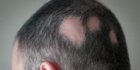 Alopecia: waarom u haar verliest en hoe u het moet behandelen