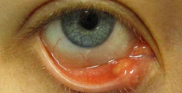 Gerst aan de binnenkant van het ooglid