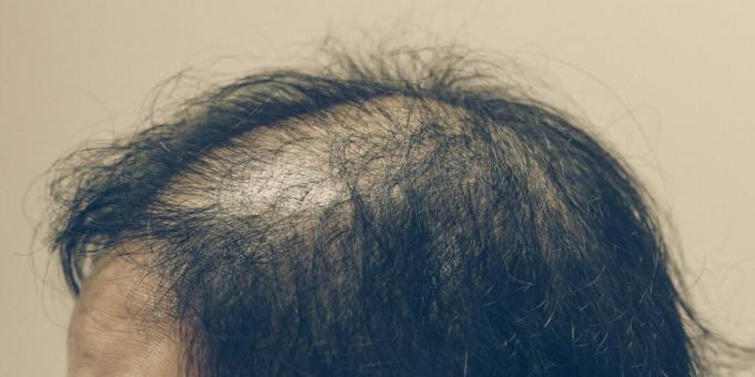 Anagene alopecia