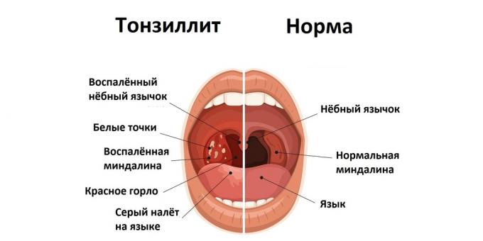 Tonsillitis en normale toestand 