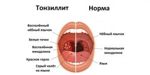 Chronische tonsillitis: symptomen, complicaties, behandeling en meer