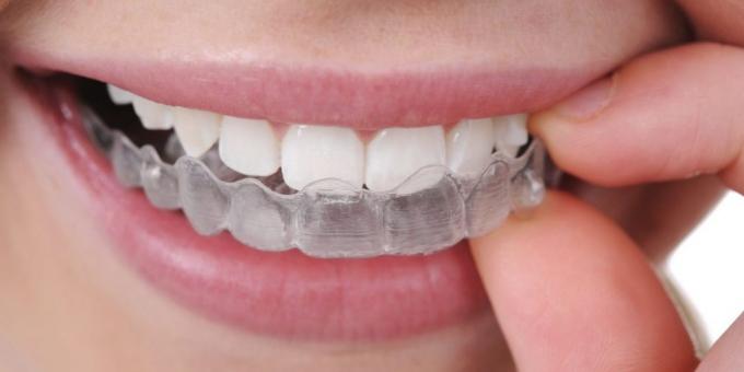 Tandenknarsen: beschermkap