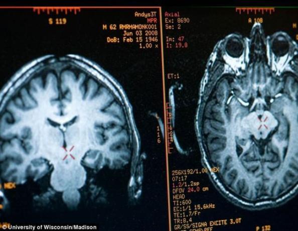 image hersenen Matthieu Ricard verkregen door middel van MRI
