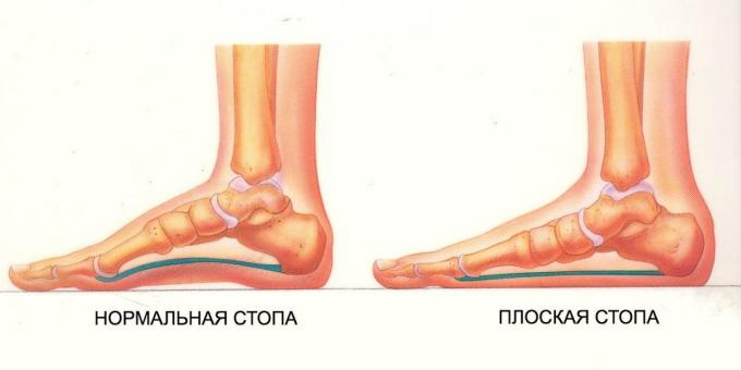oefeningen voor platte voeten: normaal en platte voet