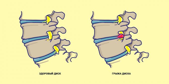 Hernia rug vergeleken met een gezonde rug