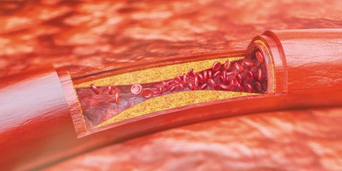 Cholesterol: atherosclerotische plaques