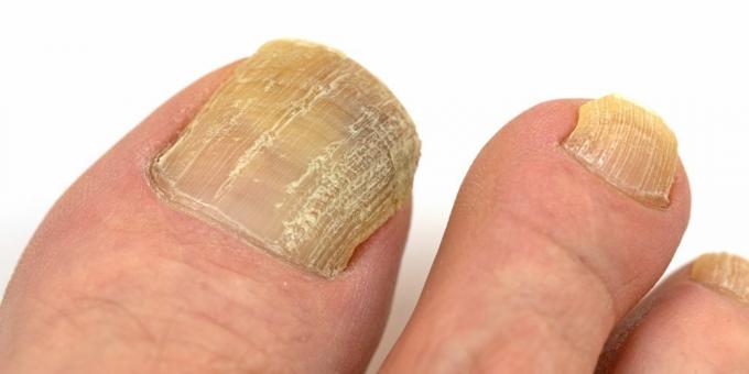Dermatomycose: nagelschimmel