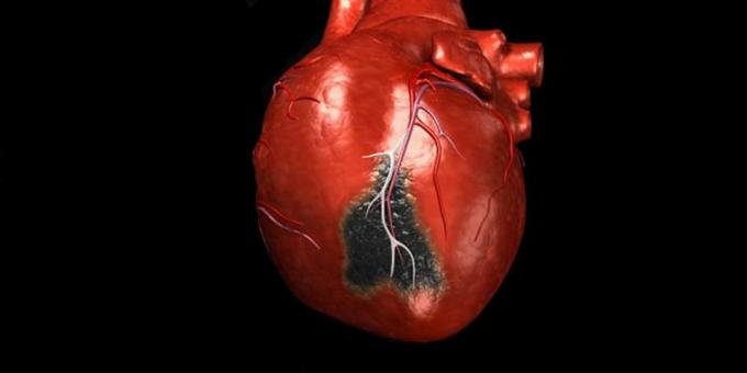 De symptomen van een hartaanval, die je nodig hebt om een ​​ambulance te bellen