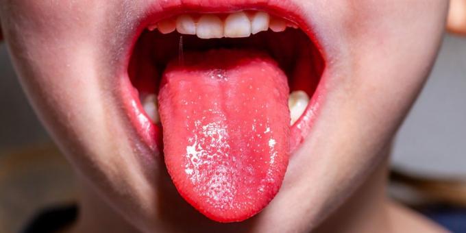 Scarlet Fever Symptoms: Strawberry Tongue