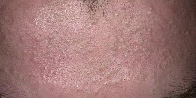Hoe zich te ontdoen van acne: Gesloten comedonen
