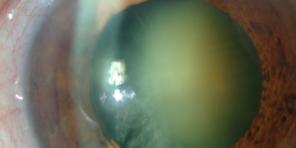 Waarom cataract zo gevaarlijk is en hoe zich te ontdoen van het
