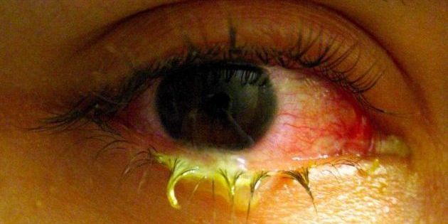 Afscheiding uit het oog met conjunctivitis