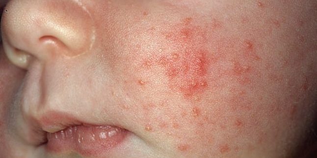 How to Get Rid van Acne: Acne Infant